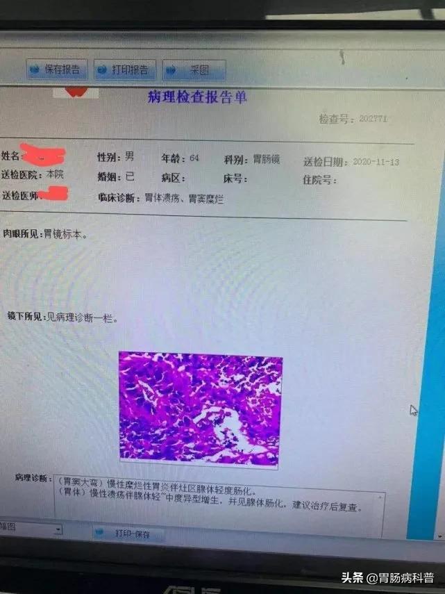 幽门螺杆菌根除治疗后4周与8周复查时机的检测差异深度解析